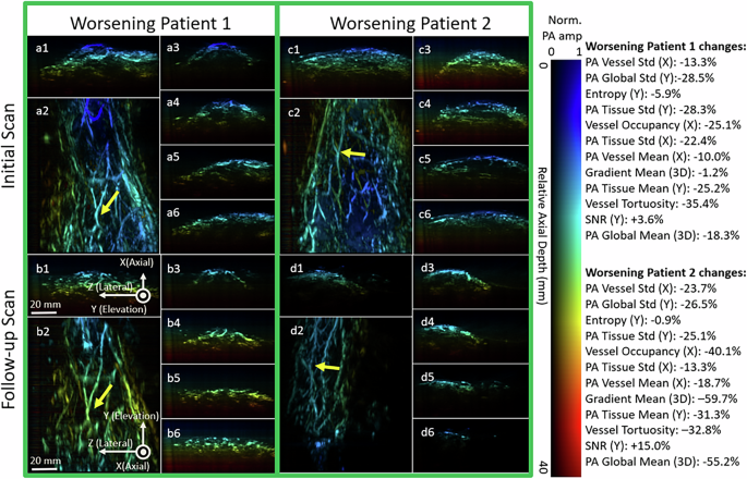 Fig. 6: Longitudinal vascular changes in worsening patients.