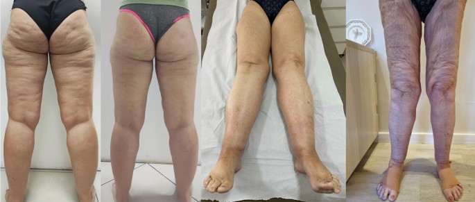 semaglutide and lipedema Unraveling lipedema: comprehensive insights and the path to future discoveries semaglutide and lipedema Unraveling lipedema: comprehensive insights and the path to future discoveries