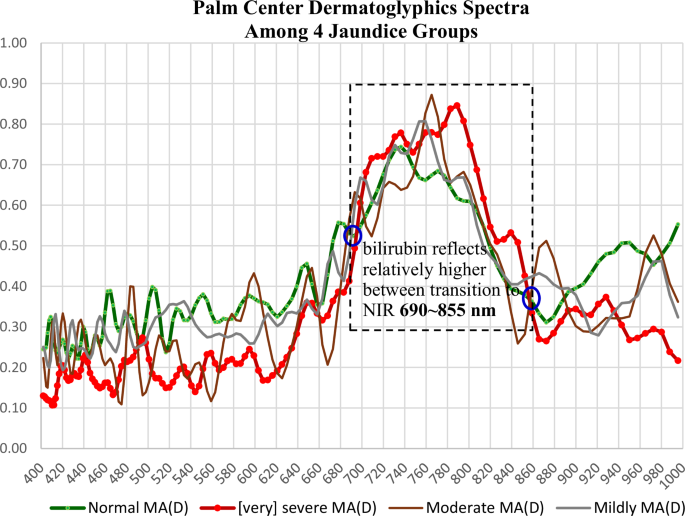 Fig. 14: HSI Z-profile spectral comparison across four jaundice groups for palmar dermatoglyphics.