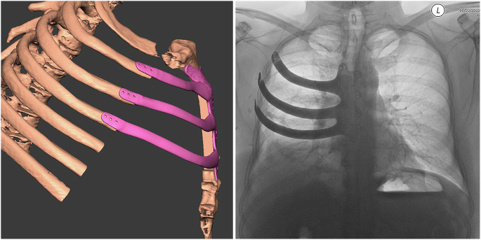 3D bioprinting the human chest wall: Fiction or fact