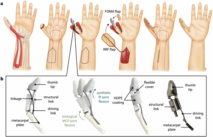 Fig. 1: Surgical approach and device design.