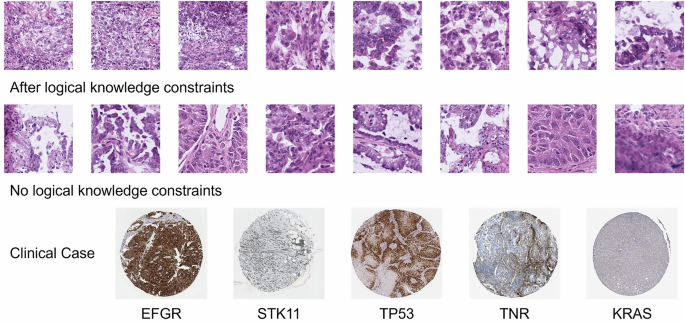 Fig. 6: Typical histopathological image patches identified with PI3K-Akt signaling pathway dysregulation.