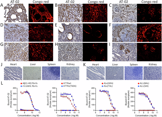 Fig. 4: AT-02 binds diverse types of human amyloid.