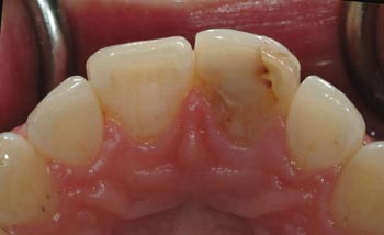 The anterior all-ceramic crown: a rationale for the choice of ceramic and  cement | British Dental Journal
