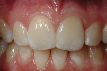 The anterior all-ceramic crown: a rationale for the choice of ceramic and  cement | British Dental Journal