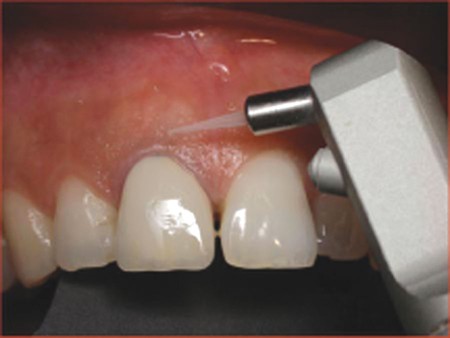 The use of the erbium yttrium aluminium garnet (2,940 nm) in a laser-assisted  apicectomy procedure | British Dental Journal