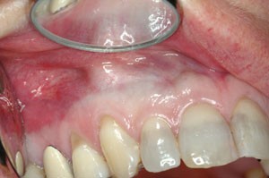Minocycline side effects teeth