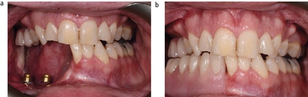 Denture Implant Retention Caps  - Blue Nylon Inserts Were Placed Into The Denture Cap Housings, Inserted Onto The Tissue Ridge, Verifying Complete Adaptation.