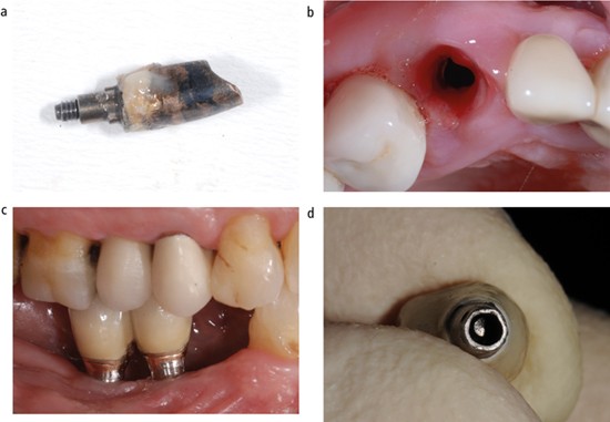 Peri-implantitis and the prosthodontist | British Dental Journal
