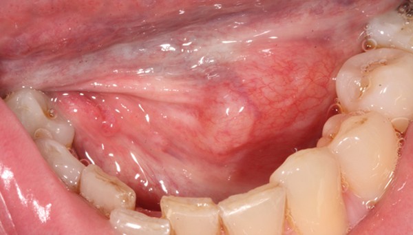 Sub Mucosal Swelling British Dental Journal