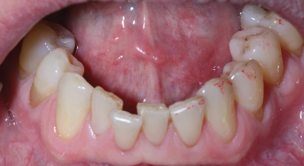 Sub Mucosal Swelling British Dental Journal