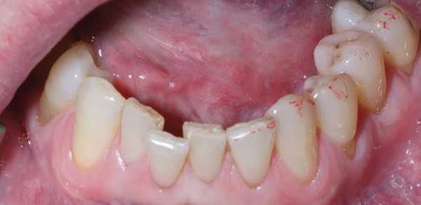 Sub Mucosal Swelling British Dental Journal