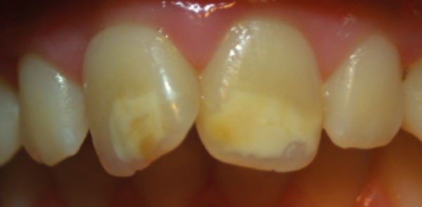 Molar Incisor Hypomineralisation Mih An Overview British Dental Journal