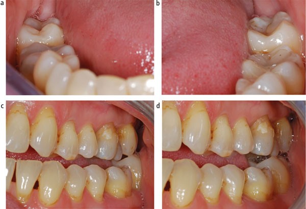 Unintended changes to the occlusion following the provision of night guards  | British Dental Journal