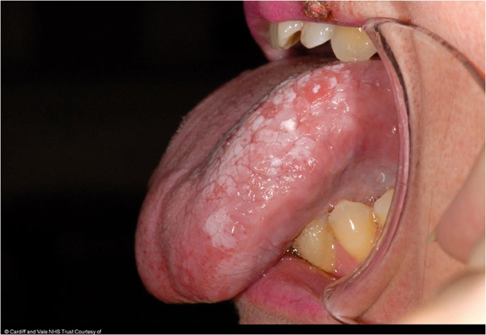 Papilloma tongue nhs