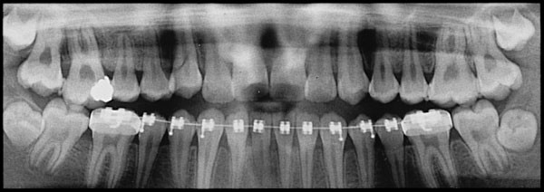 Radiographic diagnosis of root resorption in relation to orthodontics |  British Dental Journal