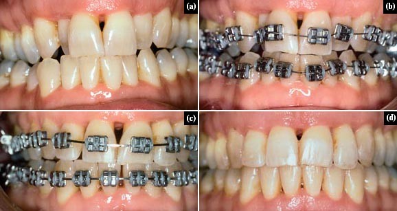 Orthodontic braces treatment in Darbhanga - Metal and ceramic braces at Aryan Dental Care