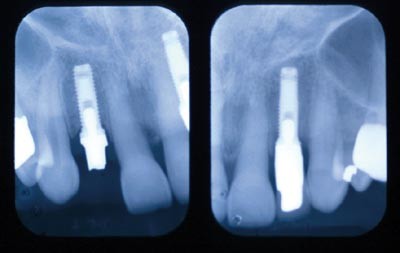 Screw versus cemented implant supported restorations | British Dental  Journal