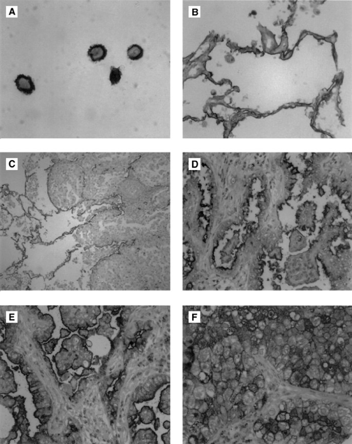 CD24 is an independent prognostic marker of survival in nonsmall cell lung  cancer patients | British Journal of Cancer