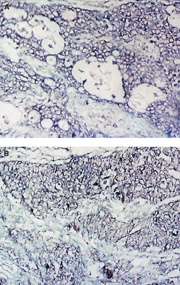 Hpv virus male. Human papillomavirus infection male Ovarian cancer yellow stool