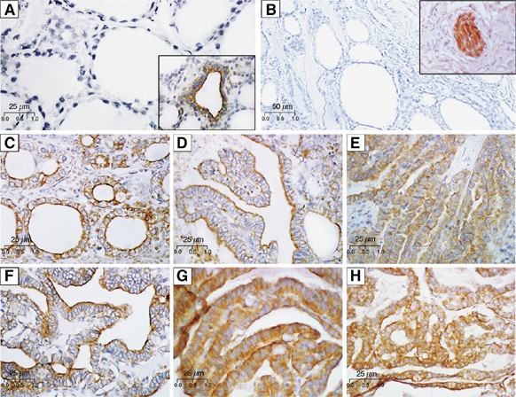 NrCAM, a neuronal system cell-adhesion molecule, is induced in papillary  thyroid carcinomas | British Journal of Cancer