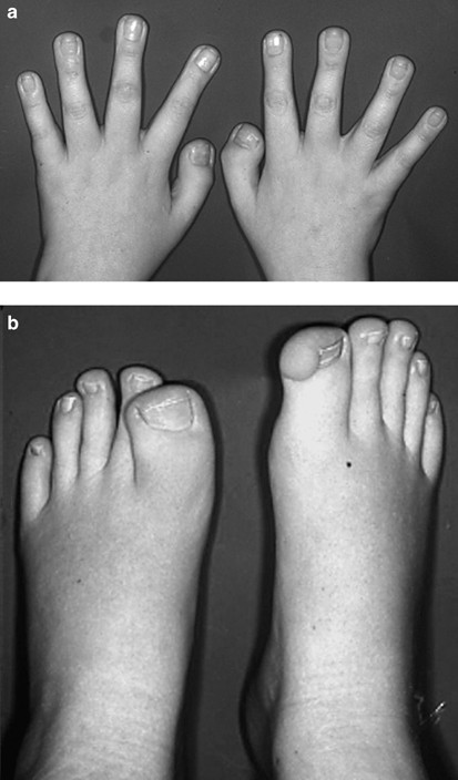 Rubinstein-Taybi syndrome: MedlinePlus Genetics