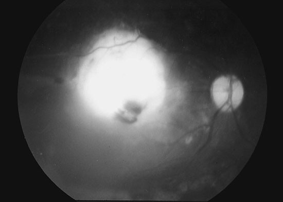 Advanced Coats' disease successfully managed with vitreo-retinal surgery |  Eye
