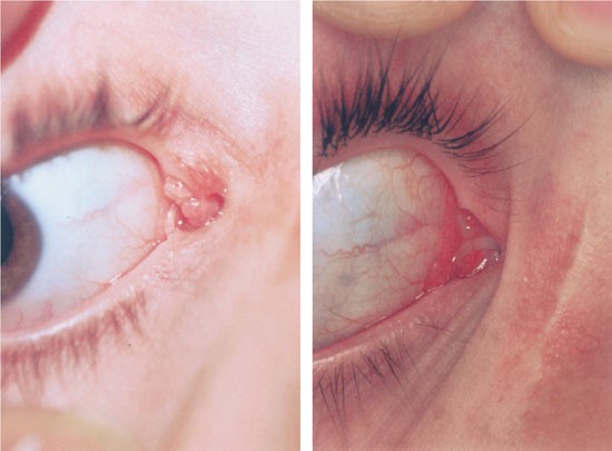 Conjunctival papilloma causes - Conjunctival papillomas