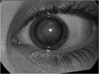 cataract diabetes kezelés népi jogorvoslati