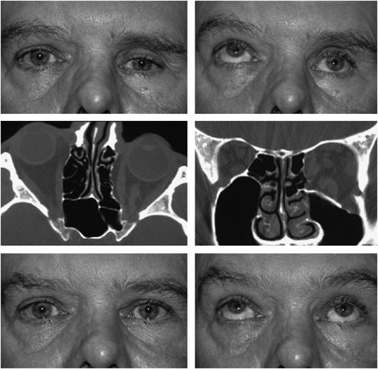 Orbital Blow Out Fractures Surgical Timing And Technique Eye