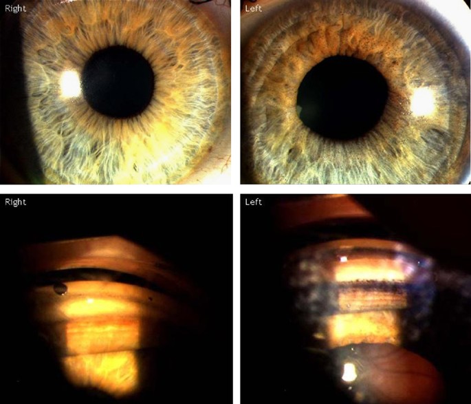 Iris damage and acute pigment dispersion following photo-epilation | Eye