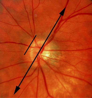 Developmental abnormalities of the optic nerve and chiasm | Eye