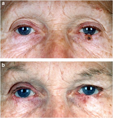 Bilateral Basal Cell Carcinoma Of The Lower Eyelids Following