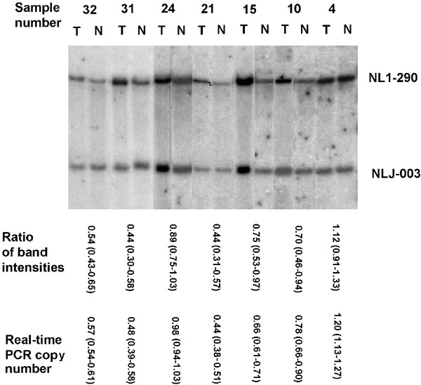 Deletion Mapping Using Quantitative Real Time Pcr Identifies Two Distinct 3p21 3 Regions Affected In Most Cervical Carcinomas Oncogene