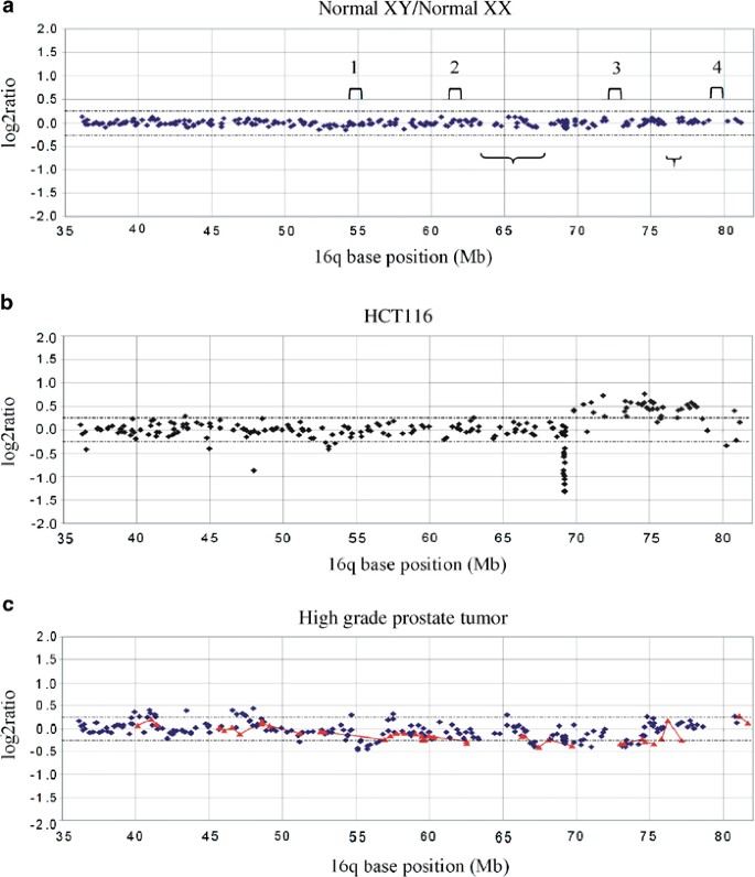 Integration Of High Resolution Array Comparative Genomic Hybridization Analysis Of Chromosome 16q With Expression Array Data Refines Common Regions Of Loss At 16q23 Qter And Identifies Underlying Candidate Tumor Suppressor Genes In Prostate Cancer