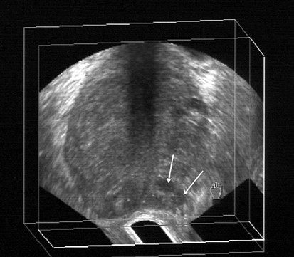 hyperechoic nodule prostate ultrasound