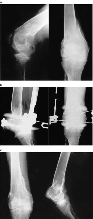 Fixation of ring fixator to proximal tibia. (a) Transverse wire