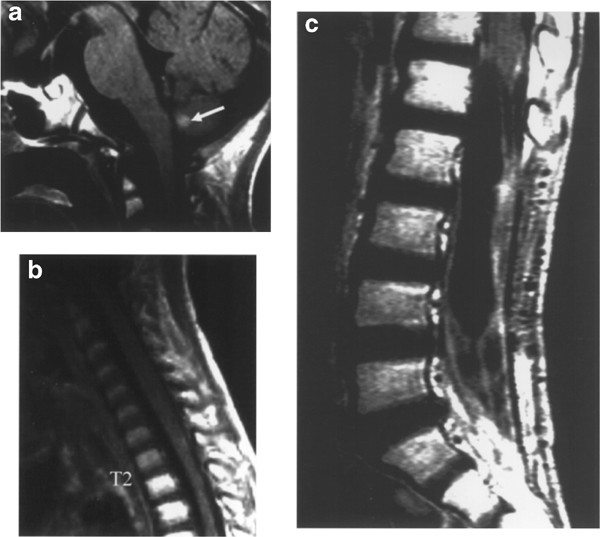 Primary malignant peripheral nerve sheath tumor of the cauda equina in a  child case report
