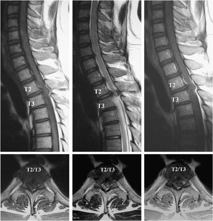 herniated disc x ray