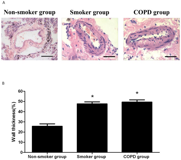 Expression variations of connective tissue growth factor in pulmonary  arteries from smokers with and without chronic obstructive pulmonary disease  | Scientific Reports