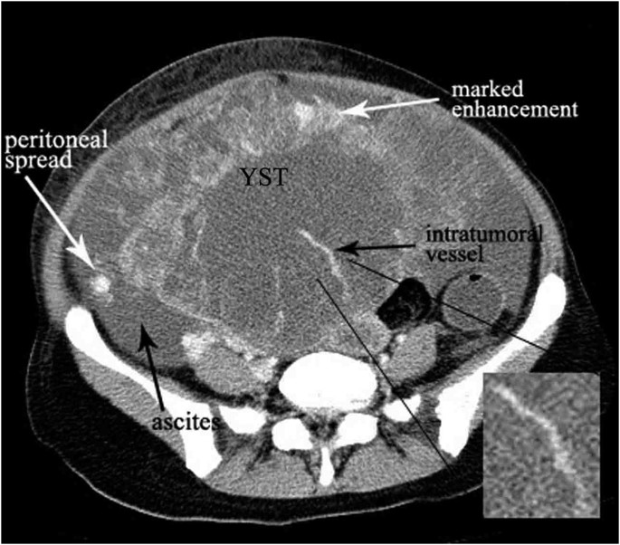 CT imaging of ovarian yolk sac tumor with emphasis on differential  diagnosis | Scientific Reports
