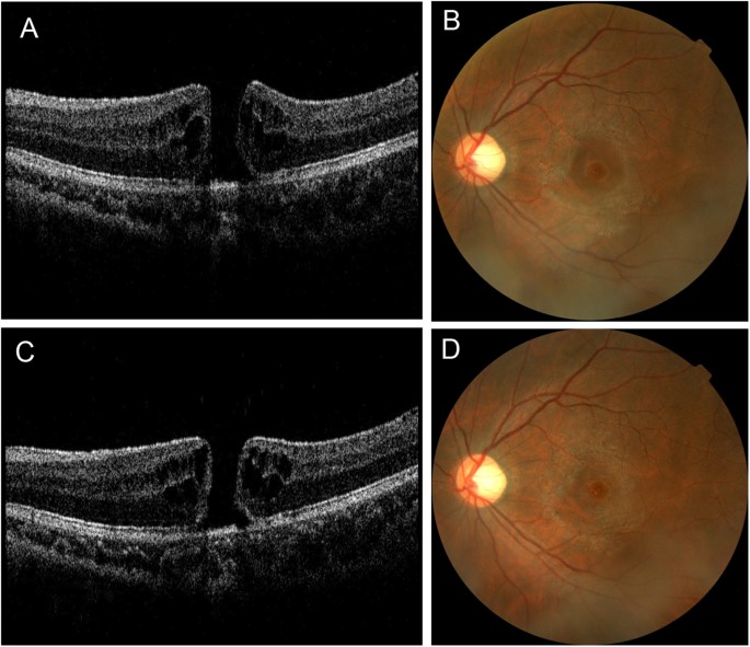 macular hole