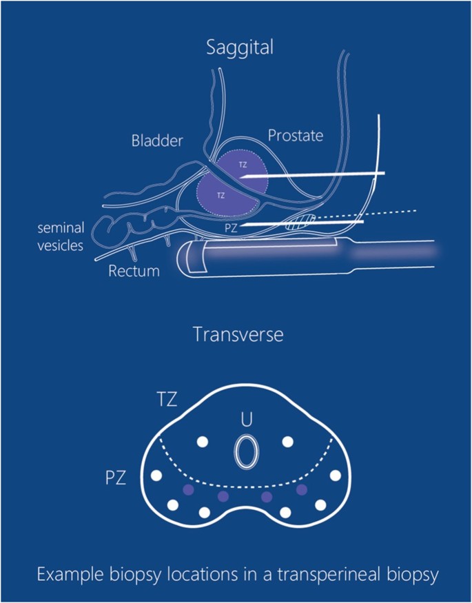 prostate ultrasound protocol glande salivare mici