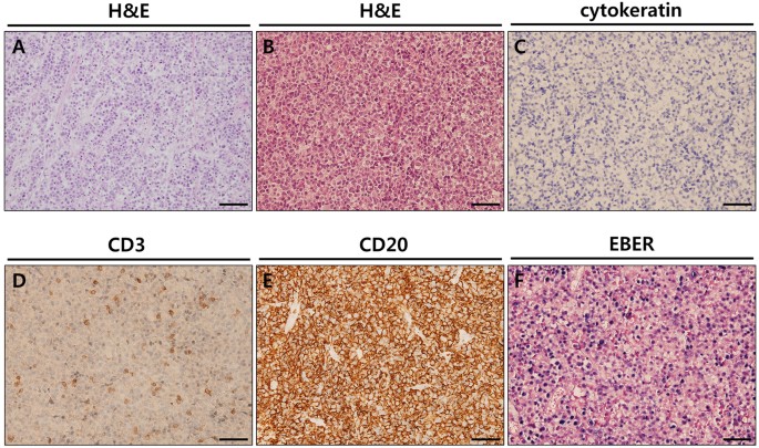 Figure 3: Representative histology of lymphoma transformed PDX tumours.