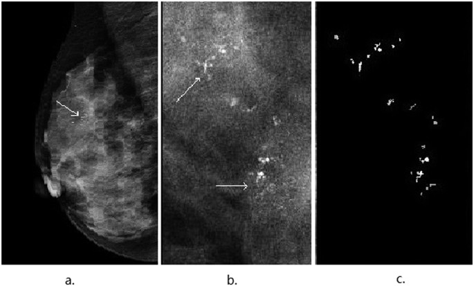 Discrimination of Breast Cancer with Microcalcifications on ...