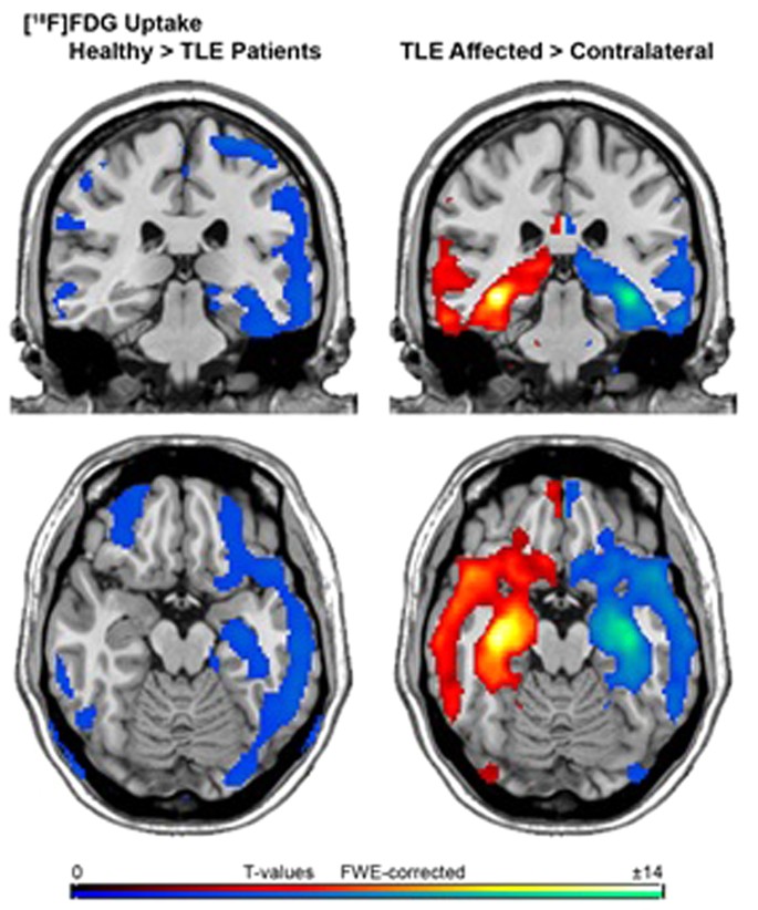 brain pet scan epilepsy