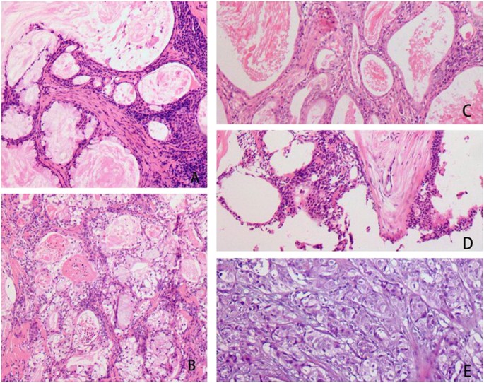 Mucoepidermoid carcinoma arising in Warthin's tumor of the parotid gland:  Clinicopathological characteristics and immunophenotypes | Scientific  Reports