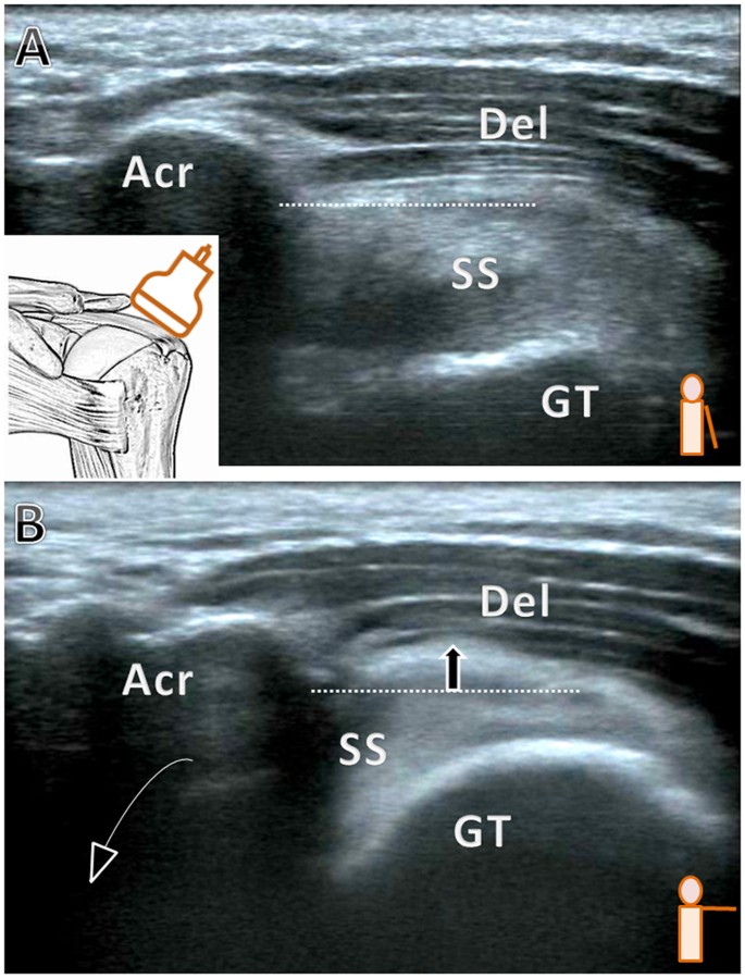 Association of Bicipital Peritendinous Effusion with Subacromial