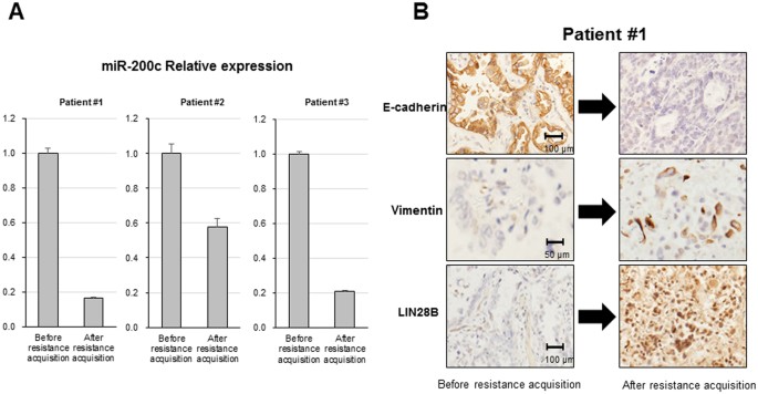Figure 6: MiR-200c downregulation and LIN28B upregulation after EGFR-TKI resistance acquisition on NSCLC tissues.