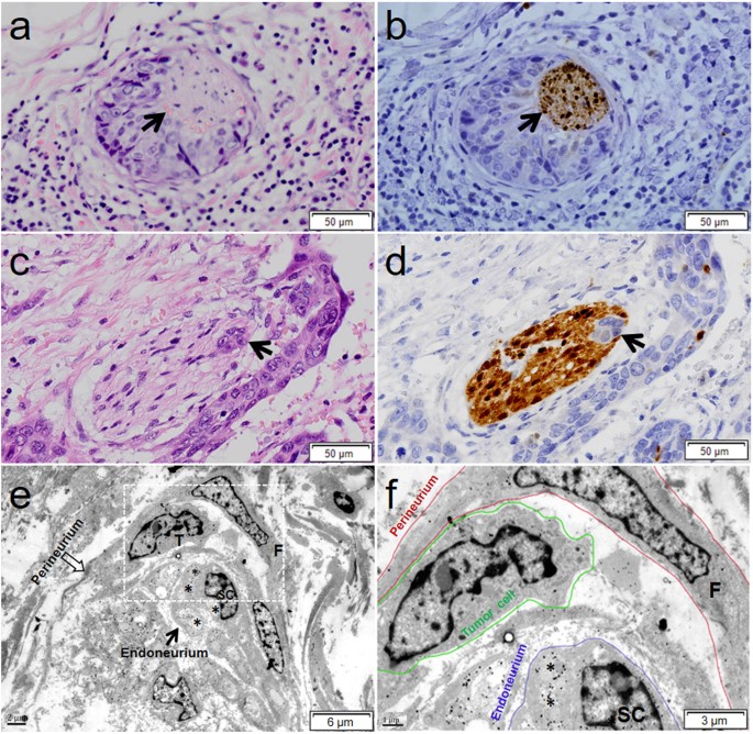 Figure 1: Representative histology and ultrastructure of PNI in ESCC.